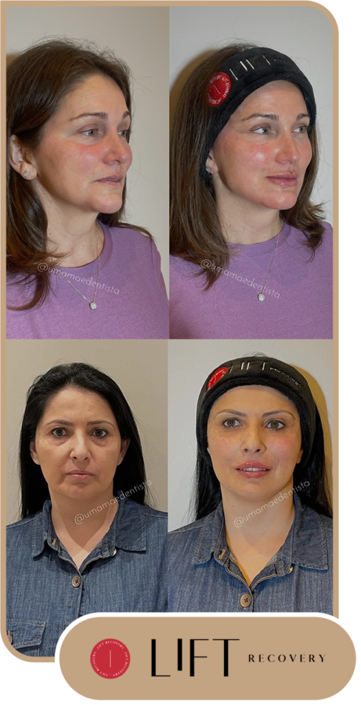 Beleza renovada com a harmonização facial – Clínica Dra Gianna